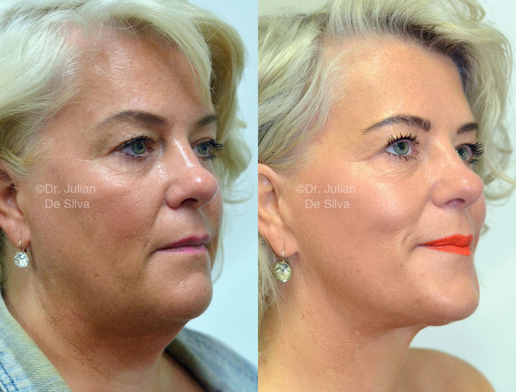 What Does A Neck Lift in London Treat?
