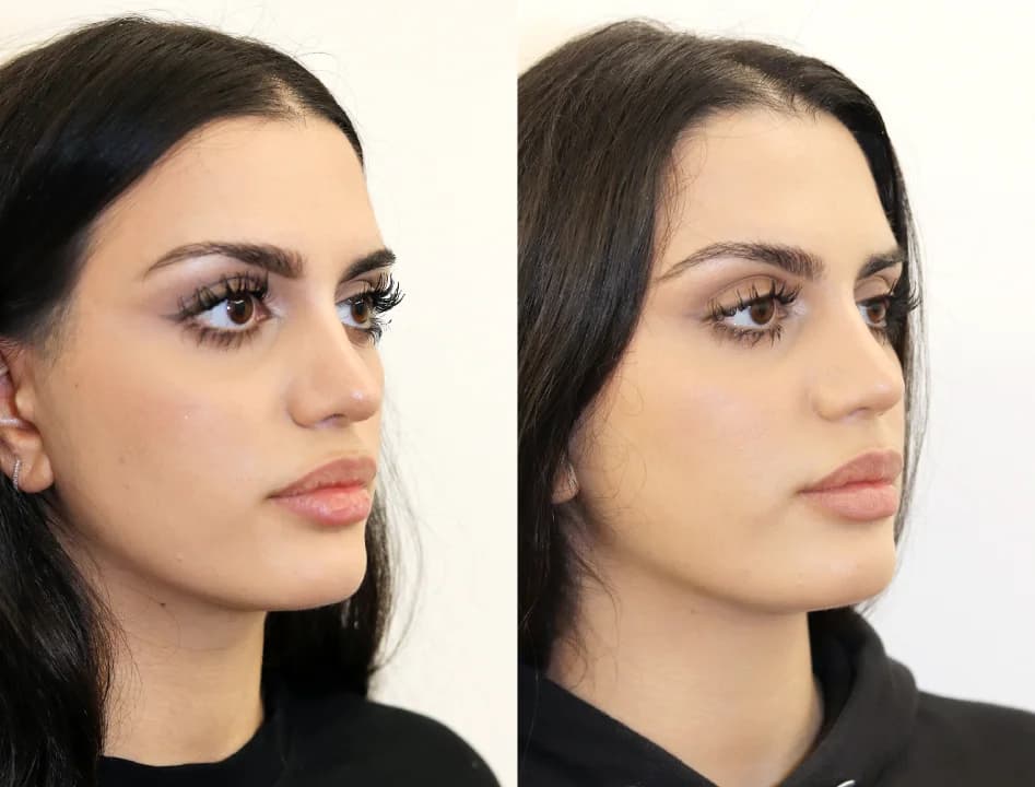 nose correction surgery: female before and after revision rhinoplasty