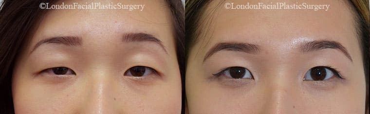 How Eyelid Anatomy Differs by Ethnicity