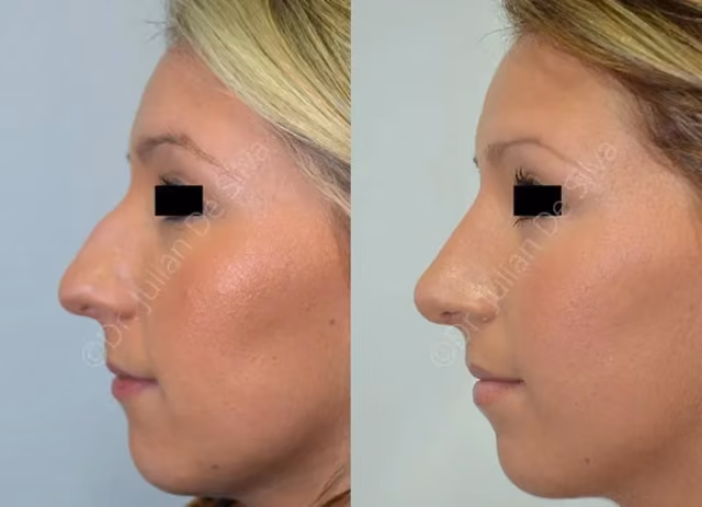 Revision Rhinoplasty Patient 1