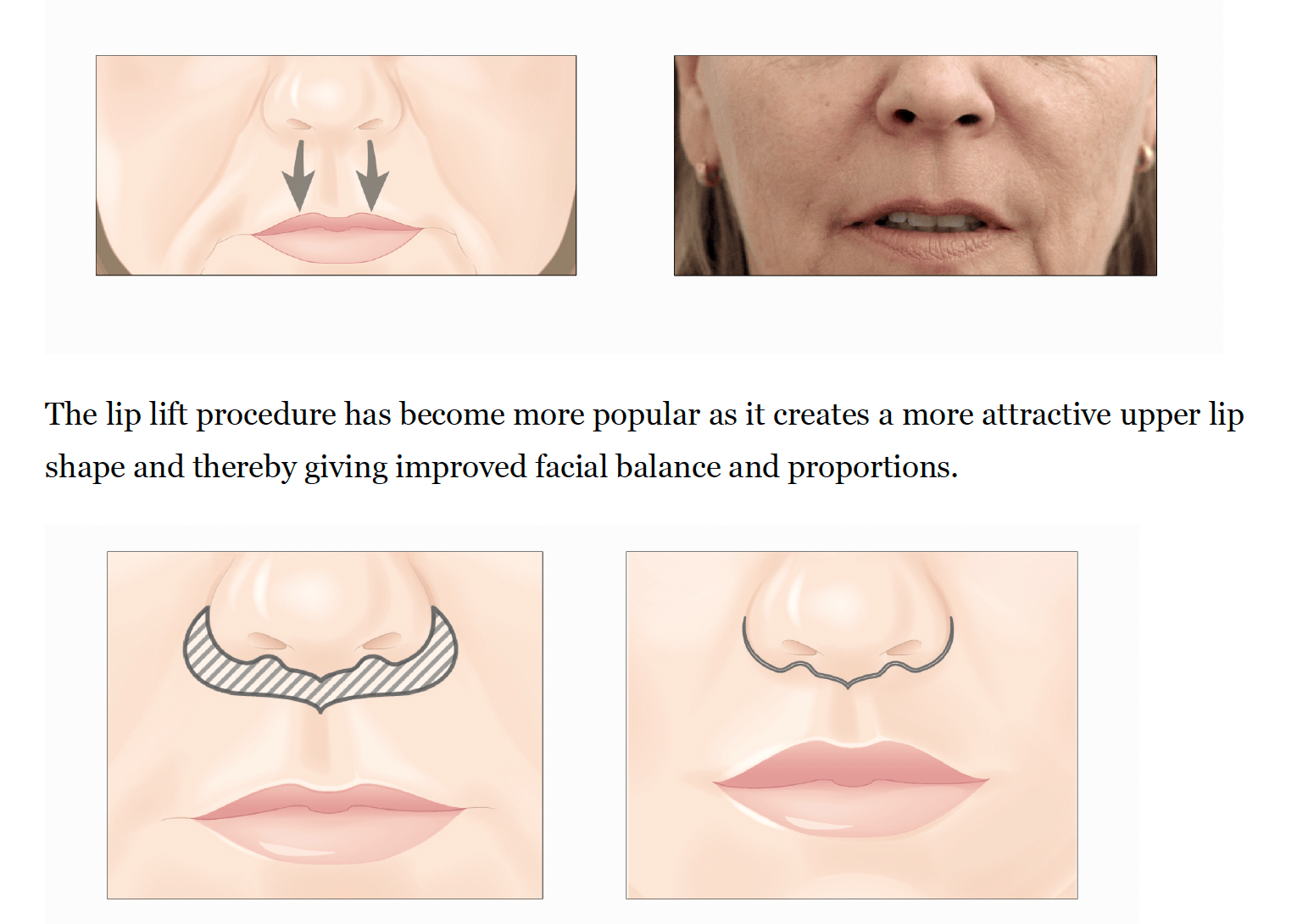 What Is Lip Lift Surgery - image
