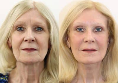 Facelift and Neck Lift 82 Ba2