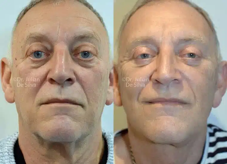 Patient face, before and after Facelift treatment, front view, patient 6