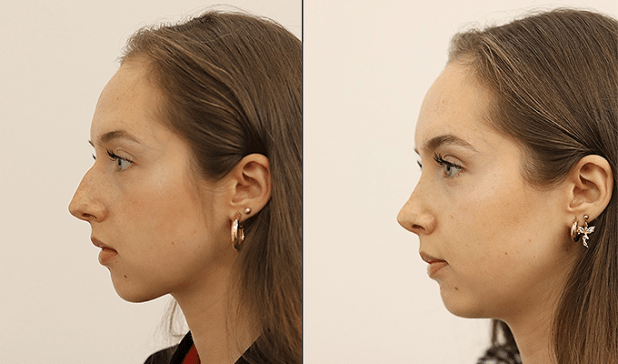 Everything You Should Consider Before Getting a Nose Job