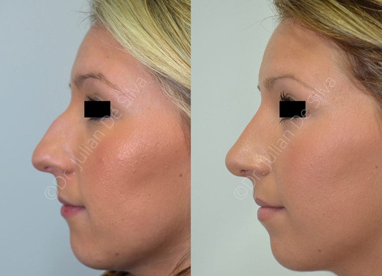 Rhinoplasty Patient 28