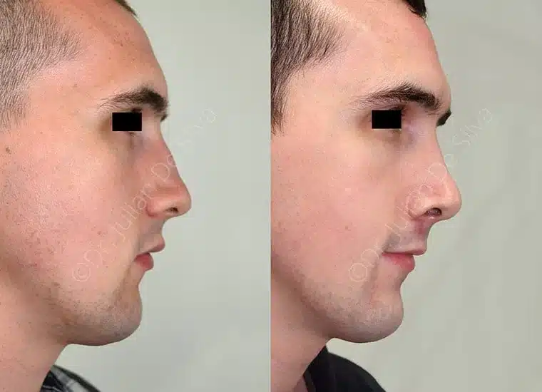 Before & After Procedure