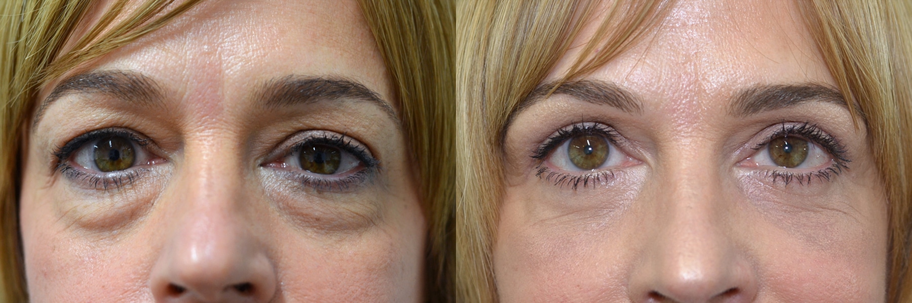 Blepharoplasty Patient 38